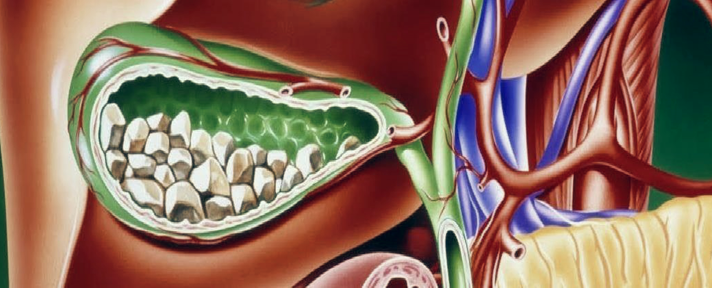 Žultspūslis, piepildīts ar akmeņiem, anatomiskā ilustrācijā