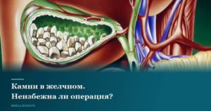 46. Камни в желчном. Неизбежна ли операция?
