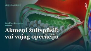 Akmeņi žultspūslī: vai vajag operāciju