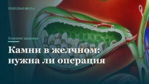 Камни в желчном: нужна ли операция